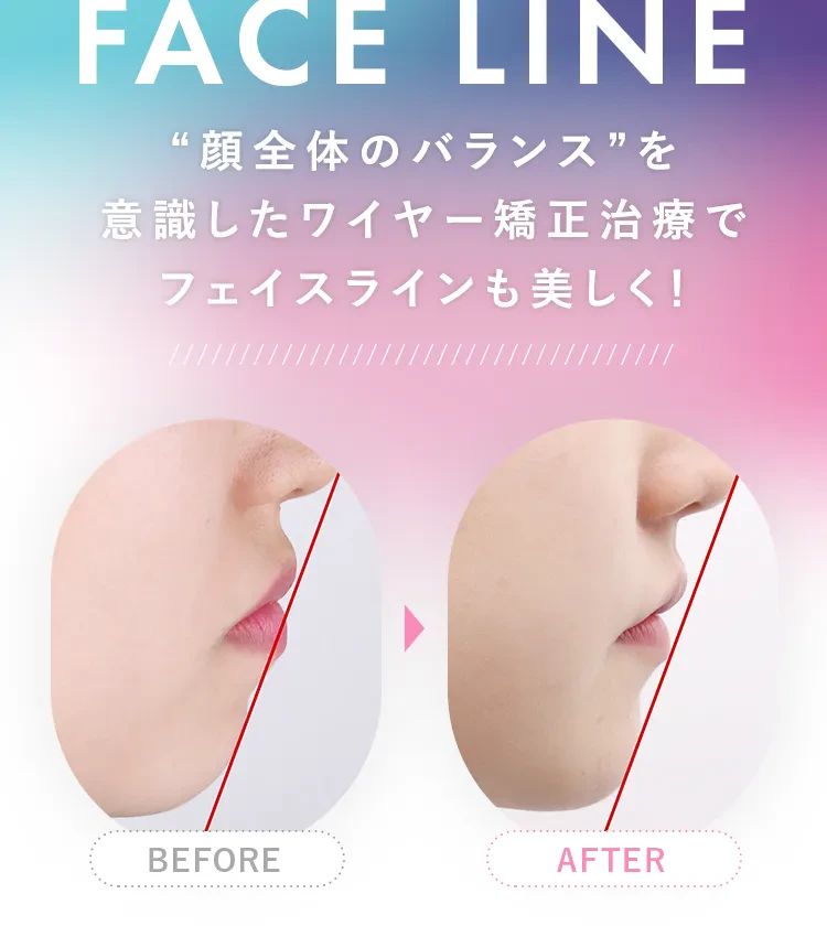 “顔全体のバランス”を意識したワイヤー矯正治療でフェイスラインも美しく!