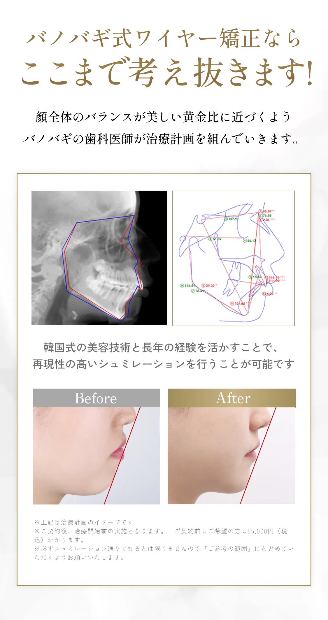 バノバギ式ワイヤー矯正ならここまで考え抜きます!